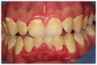 Placa Bacteriana Dentista Barcelos - ONECARE
